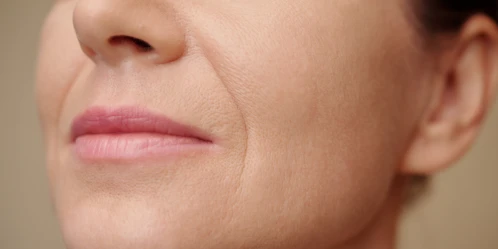 Gülüş Çizgilerini Azaltmanın Yolları-Nasolabial Kırışıklıklar İçin Biofiller ile Doğal Çözümler