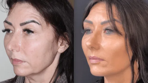 Derin Plan Yüz Germe öncesi sonrası sonucu