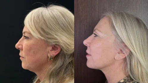 Natalia Cassel yüz germe öncesi sonrası - 1
