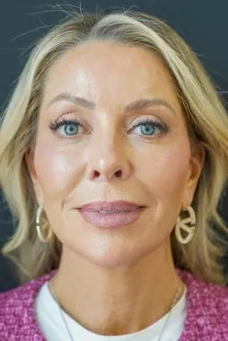 Juliet Mayhew mini facelift iyileşme ve sonuç süreci