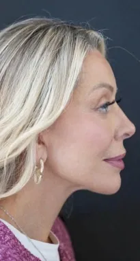 Juliet Mayhew mini yüz germe sonrası 1