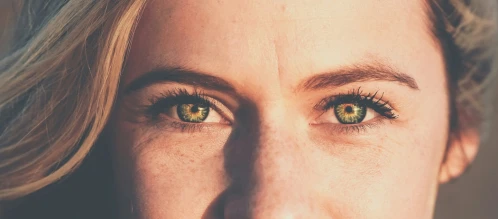 Aesthetic Surgery Journal: Eyebrow Asymmetry: Definition and Symmetrical Correction Using Botulinum Toxin A